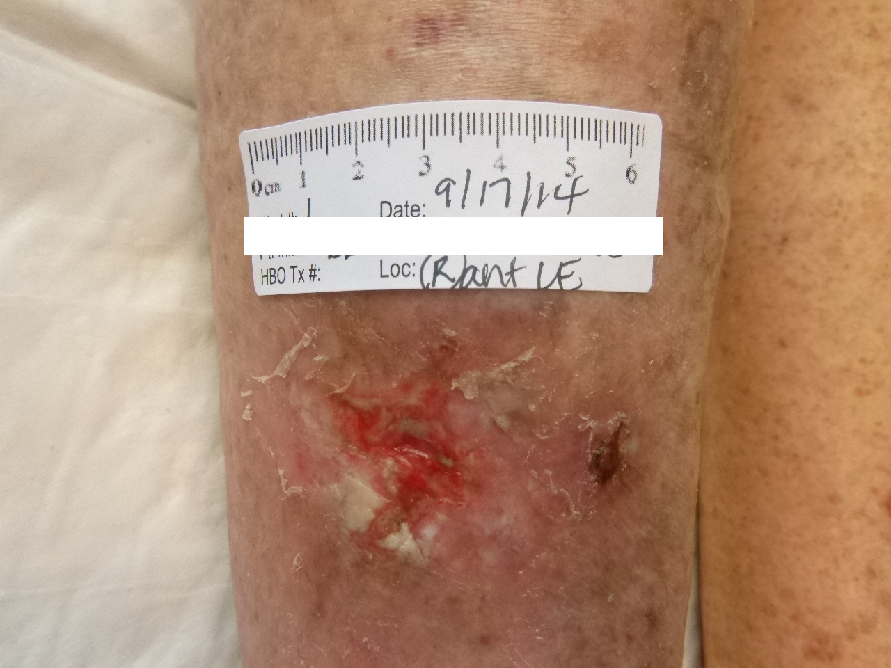 Hydroxyurea induced leg ulcers